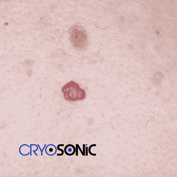 Looking for pain free cherry angioma removal treatment Widnes? Call our team today! Widnes