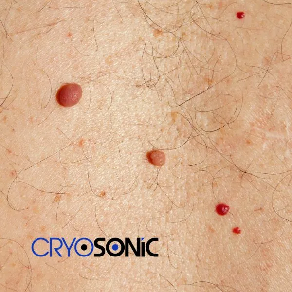 get cherry angioma removal treatment today! Widnes