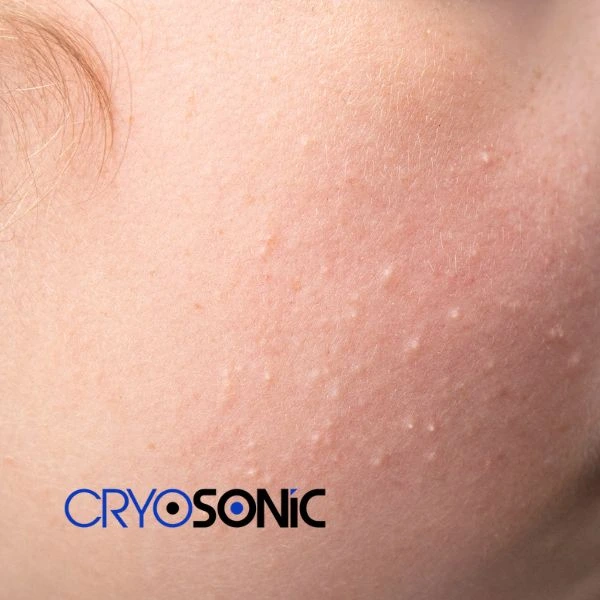 Are you looking for milia removal treatment? Contact our team today Widnes