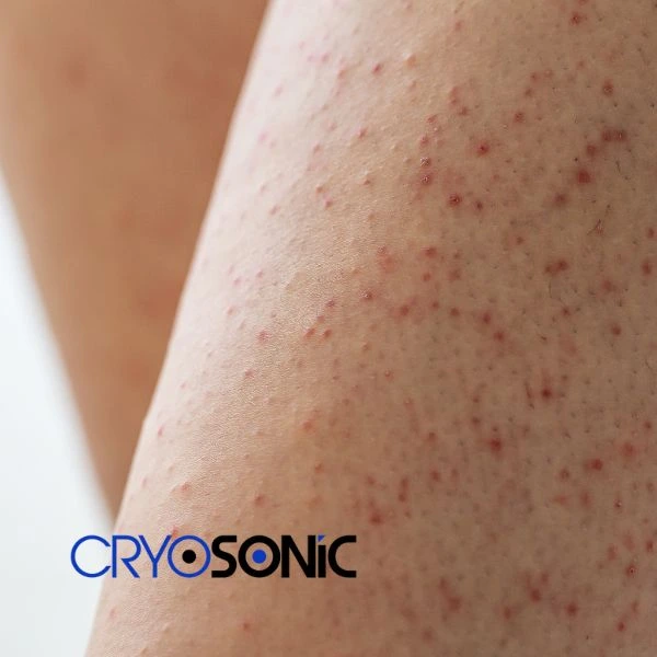 Looking for Seborrhoeic Keratosis removal Widnes treatment? Call our consultants today in Widnes