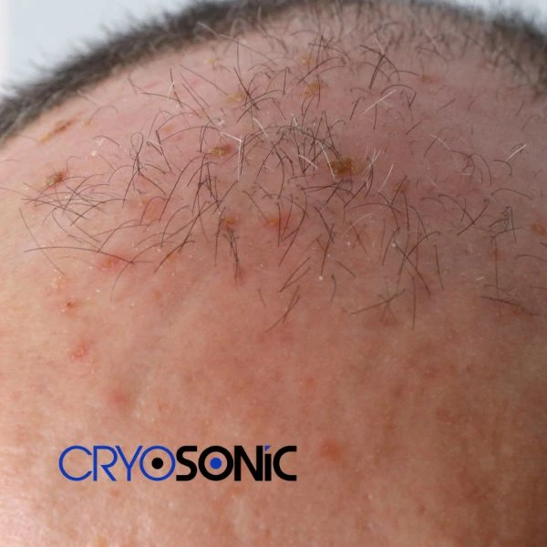 Access Seborrhoeic Keratosis removal from the comfort of your own home! Call us today in Widnes