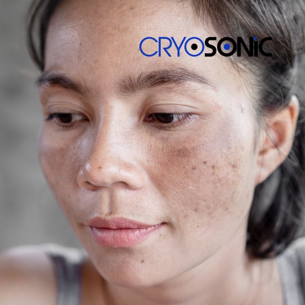 Ready to start age spots removal? Contact our team today in Widnes