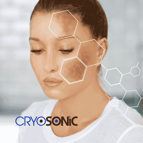 Are you looking for age spot removal treatment? Contact Cryosonic today in Widnes
