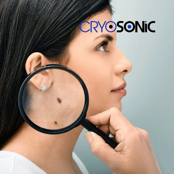 Do you want to learn more about benign moles removal treatment? Call our team today Widnes