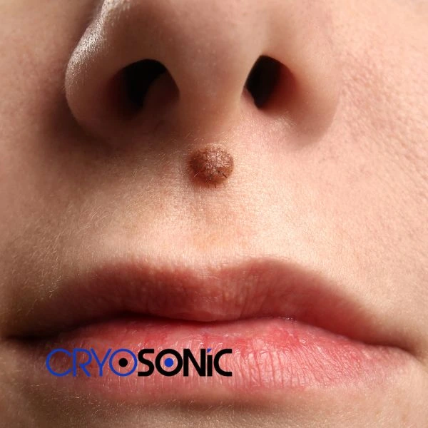 Start your benign moles removal treatment today Widnes