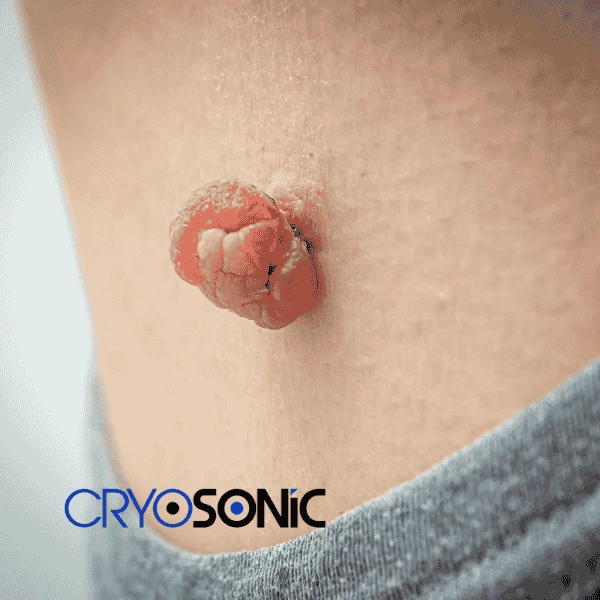 Book your skin tags removal Widnes from comfort of your own home! Widnes