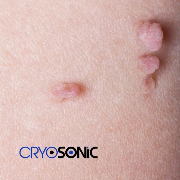 Are you looking for fast effect skin tag removal Widnes? Book in NOW! Widnes