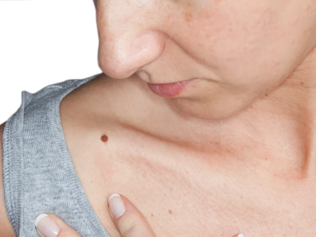 How Does CryoPen Sun Damage Treatment Widnes Work? Widnes