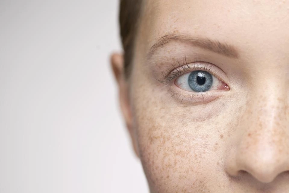 Understanding Sun Damage: How UV Rays Alter Skin and How CryoPen Can Reverse It Widnes