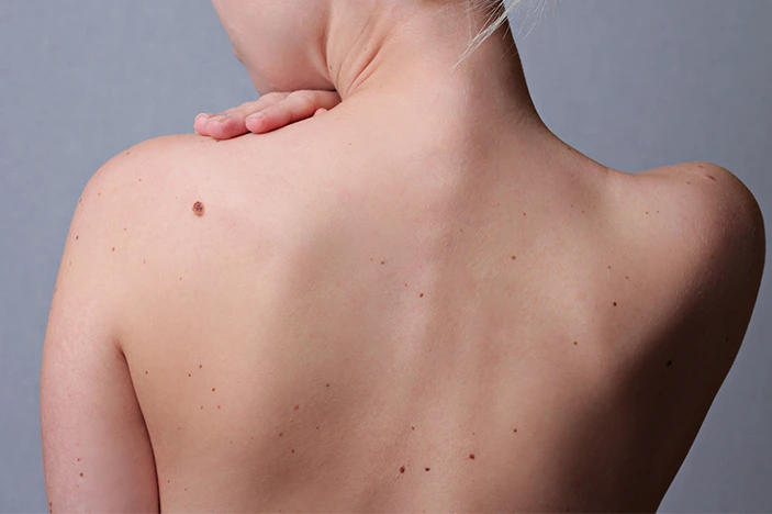 The Skin’s Healing Journey After CryoPen Sun Damage Treatment Widnes
