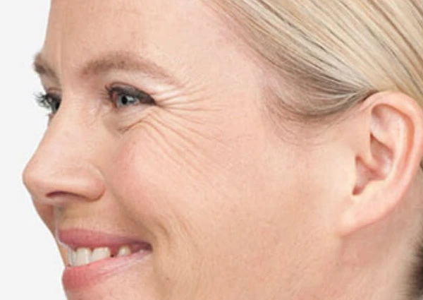 CryoPen Precision vs. Laser: Which Is Better for Sun-Damaged Skin? Widnes