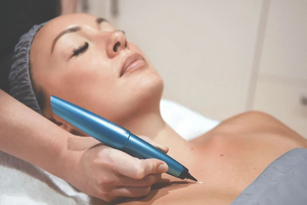 What is CryoPen Technology Widnes? Widnes