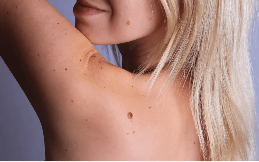 What Are Sun Spots and Pigmentation Widnes? Widnes