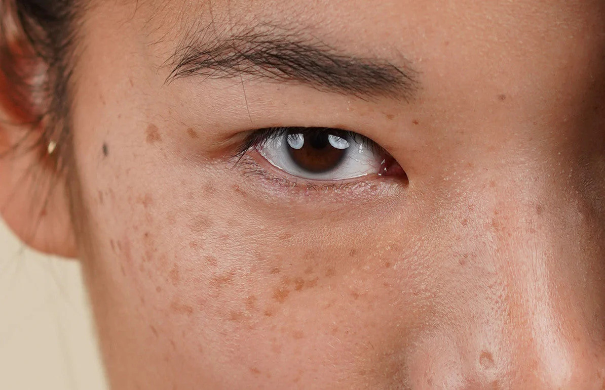 Is There Any Risk of Scarring or Pigmentation Widnes? Widnes