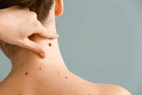 Who Should Avoid CryoPen Treatments? Widnes