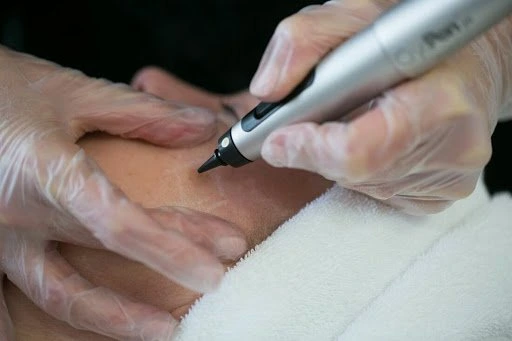 The CryoPen Technology Explained: How Extreme Cold Removes Sun-Damaged Skin Cells Widnes