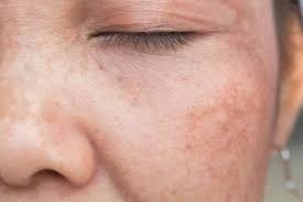 CryoPen Precision vs. Laser: Are Both Treatments Safe? Widnes