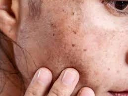 Why CryoPen Works Best for Isolated Sun Spots and Pigmentation Widnes