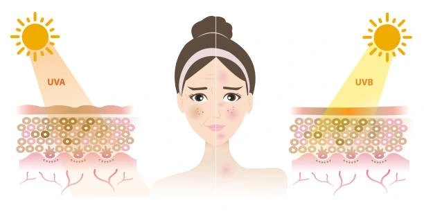 Understanding Sun Damage Widnes : How Do UV Rays Cause Changes in the Skin? Widnes