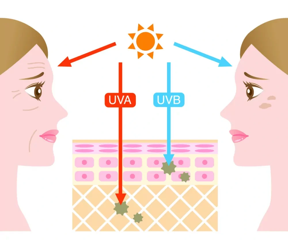 Understanding Sun Damage Widnes - Why Should Sun Damage Be Treated Early? Widnes
